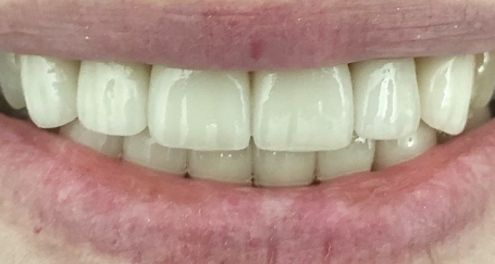 Bright white and perfectly repaired top teeth